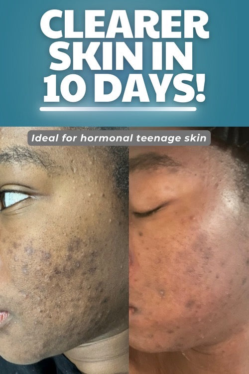 Brightening Cream w/Kojic Acid